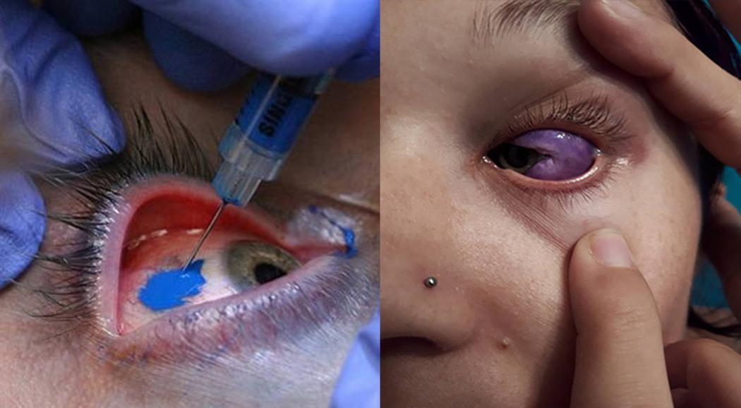 Modelka może stracić wzrok przez spartaczony tatuaż oka - VICE