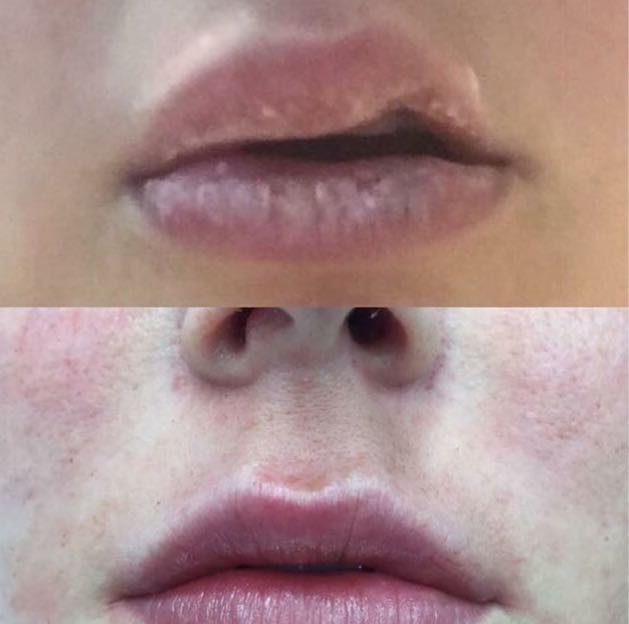 Cazurile nasoale când buzele cu acid hialuronic au distrus vieți