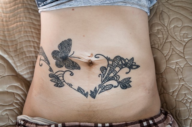 Tattoo bauch narbe am Narbenschmerzen: Ursache