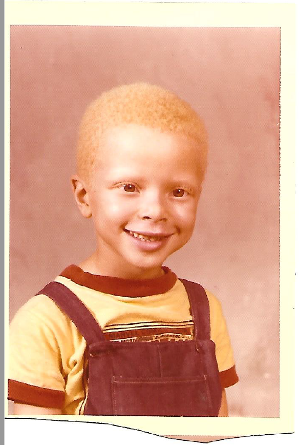 albino black person