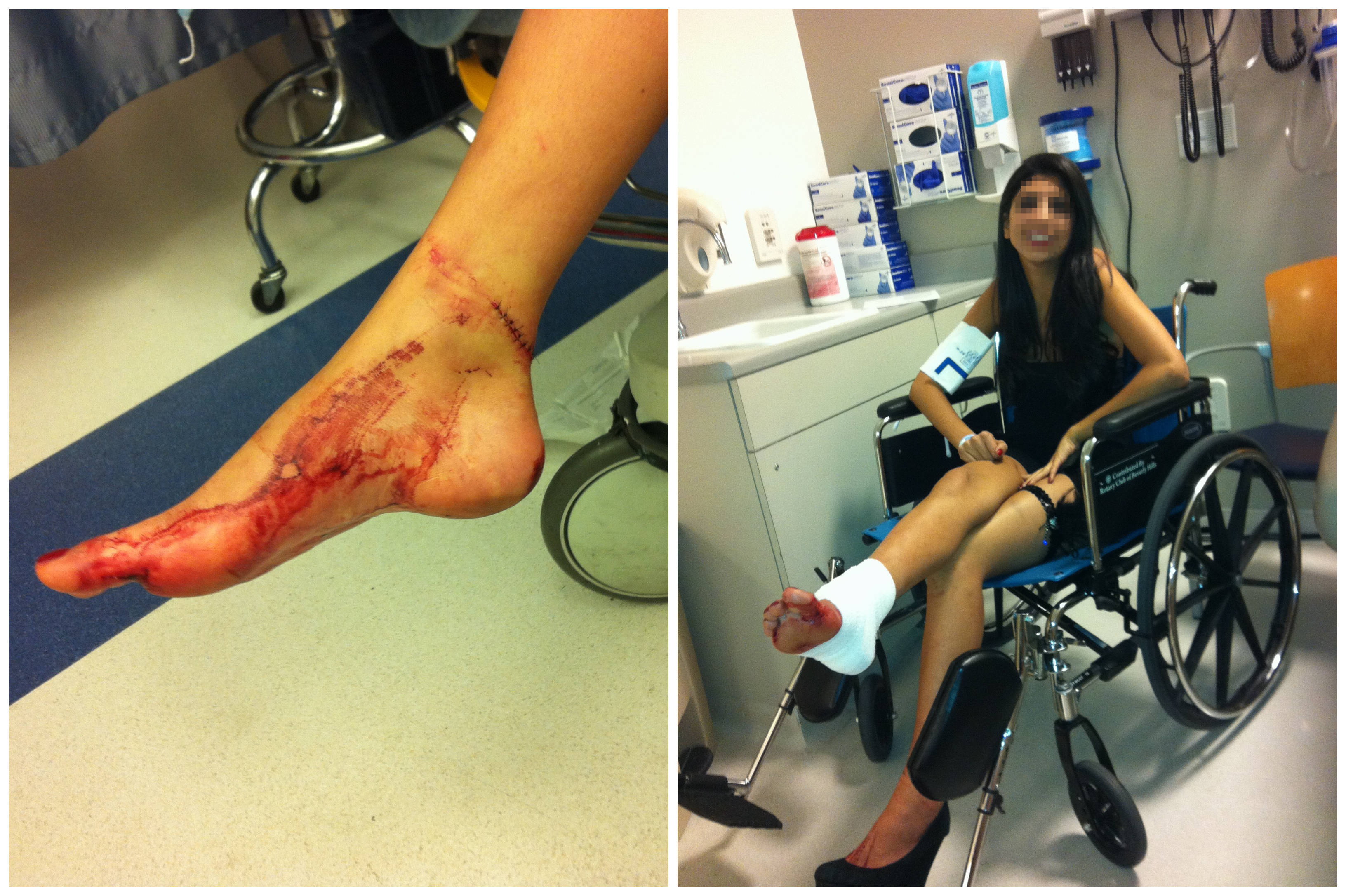 On the left, a close up of a cut and bloody right foot. On the right, a woman sitting in a wheelchair with a raised bandaged right foot.
