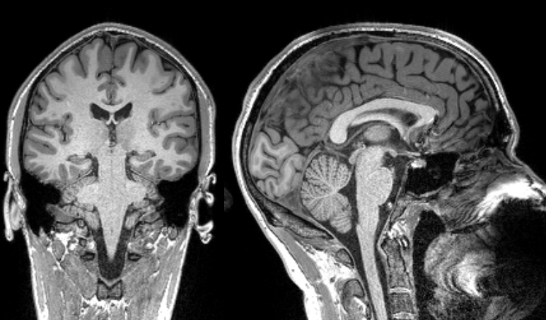 A structural image of the author’s brain taken in an MRI machine directly before he was dosed with salvia. Image: Johns Hopkins University