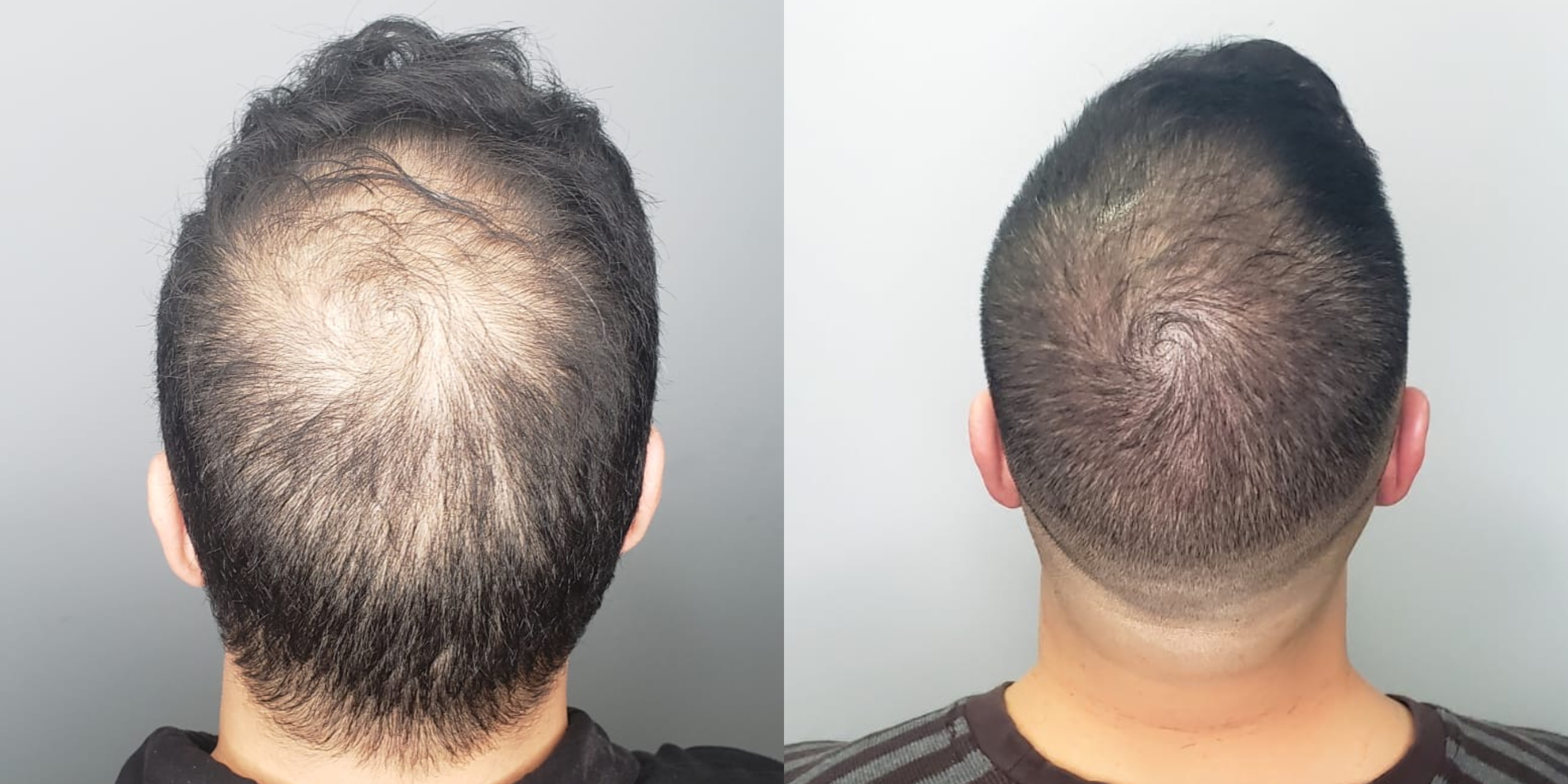 Scalp micropigmentation  SMP  Hair Tattoo Perth