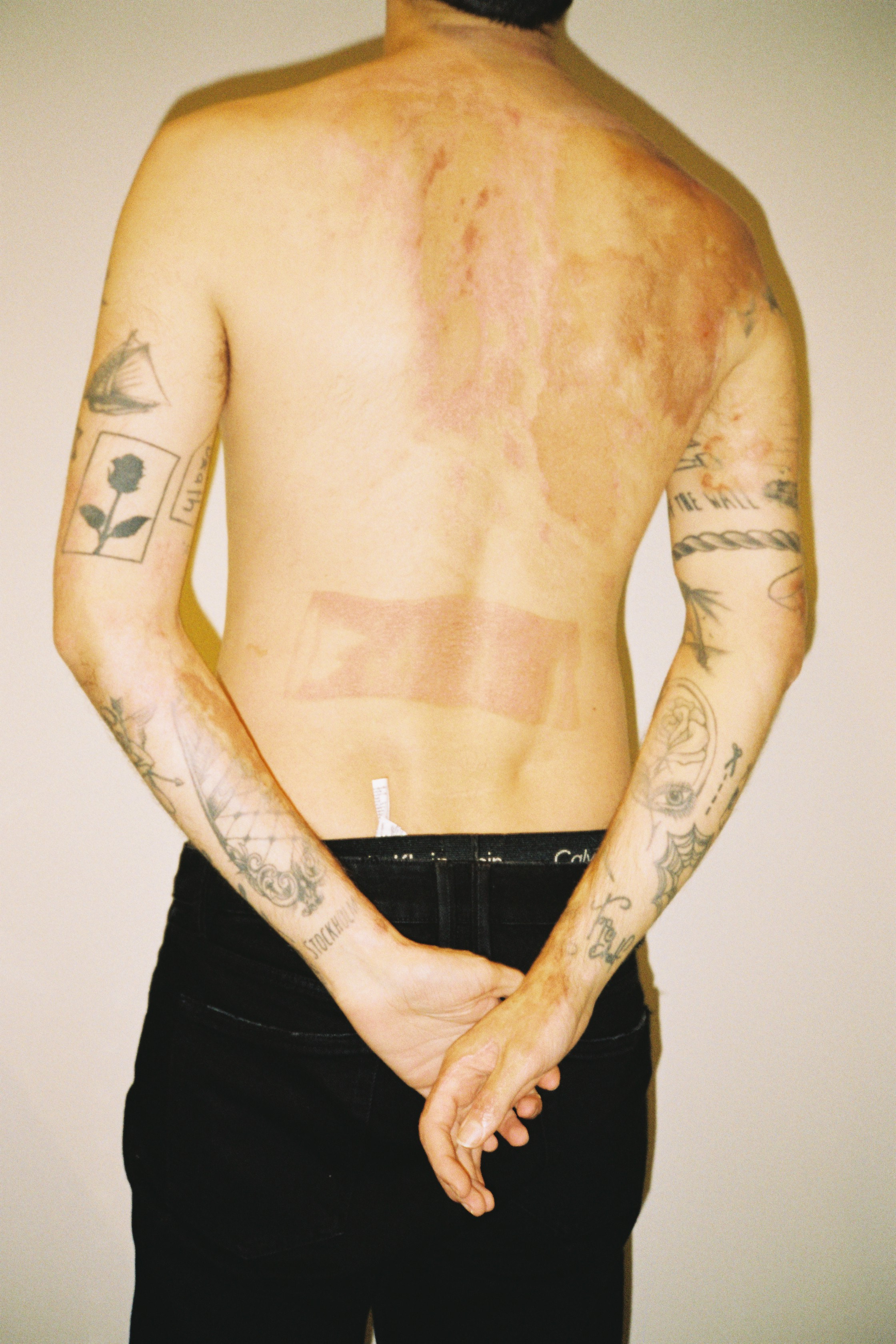 Someone with tattoos stands with their back to the camera with burn marks on it.