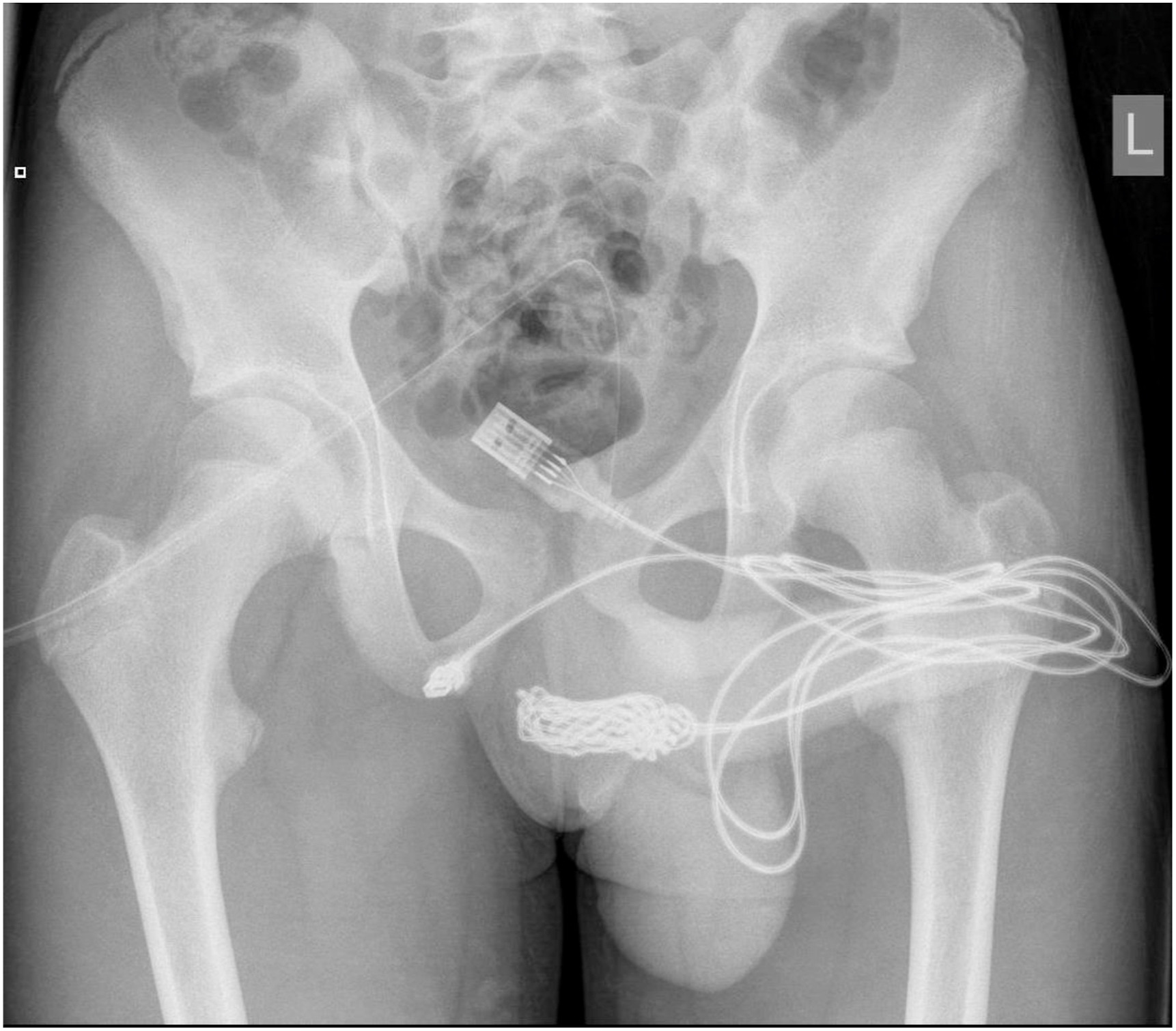 Foto rontgen yang dicantumkan dalam makalah “Urethral Self-Insertion Of A Usb Cable As Sexual Experimentation: A Case Report”.
