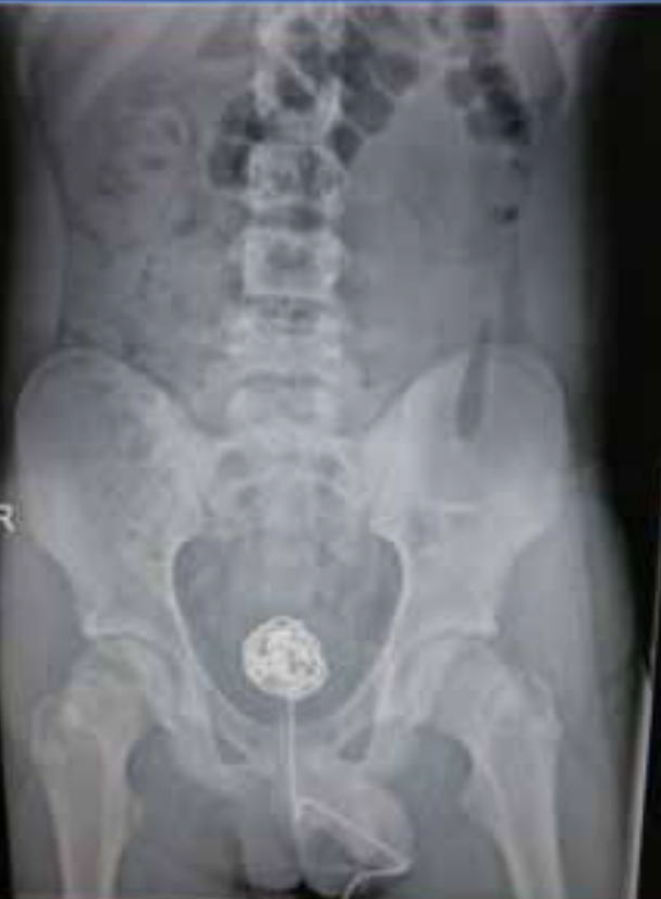 Foto rontgen yang dicantumkan dalam makalah “Video Game Cable In Urethral Meatus With Ball Retained In Bladder. First Case In The World”.