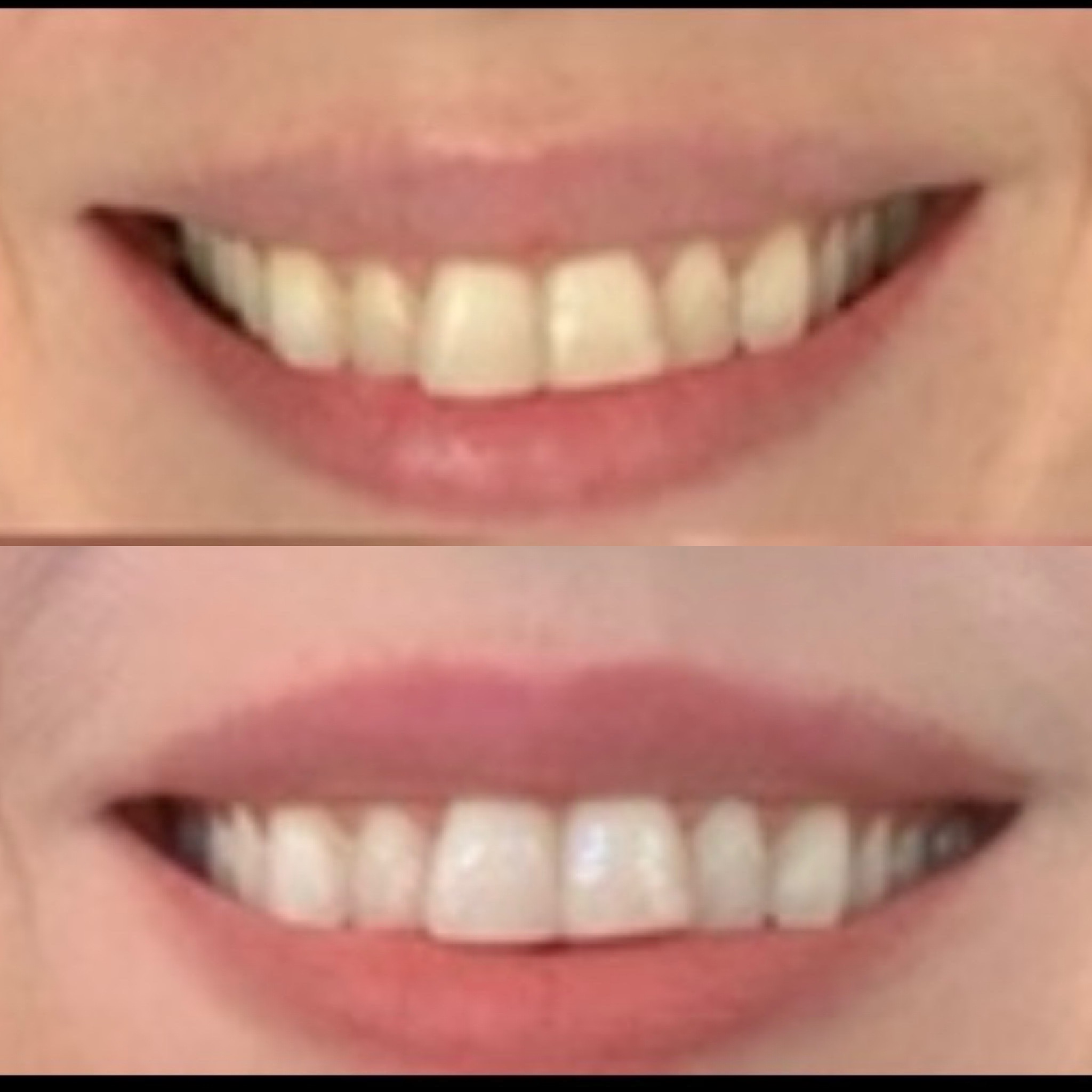 Crest 3D Whitestrips before after