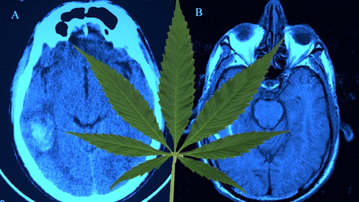 Efecto de la marihuanas en el cerebro