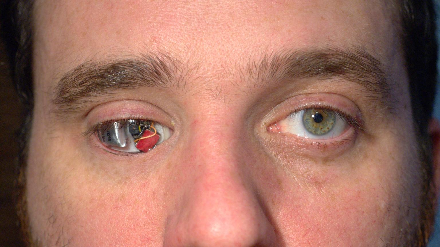 Siliconul din ochi afectează vederea. Apariția hemoragiilor pe cornee