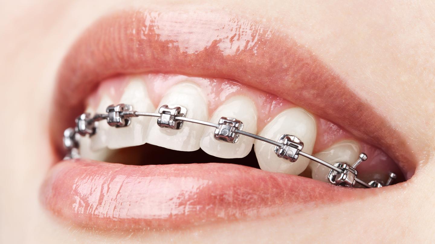 Braces Are Actually Bad For Your Teeth