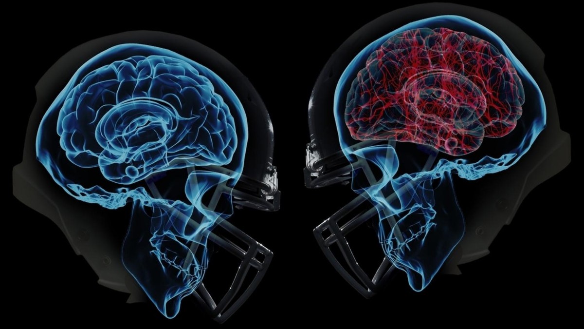 Do Helmets Prevent Concussions