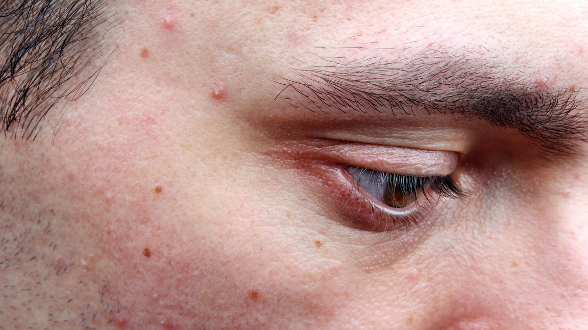 Researchers Have a New Explanation for Adult Acne