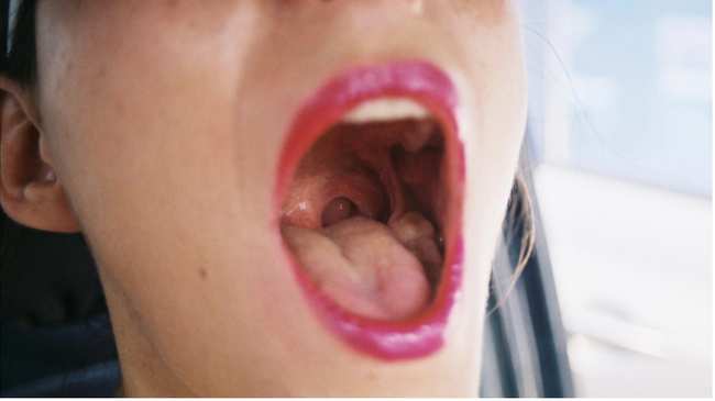 Gonorrhea throat