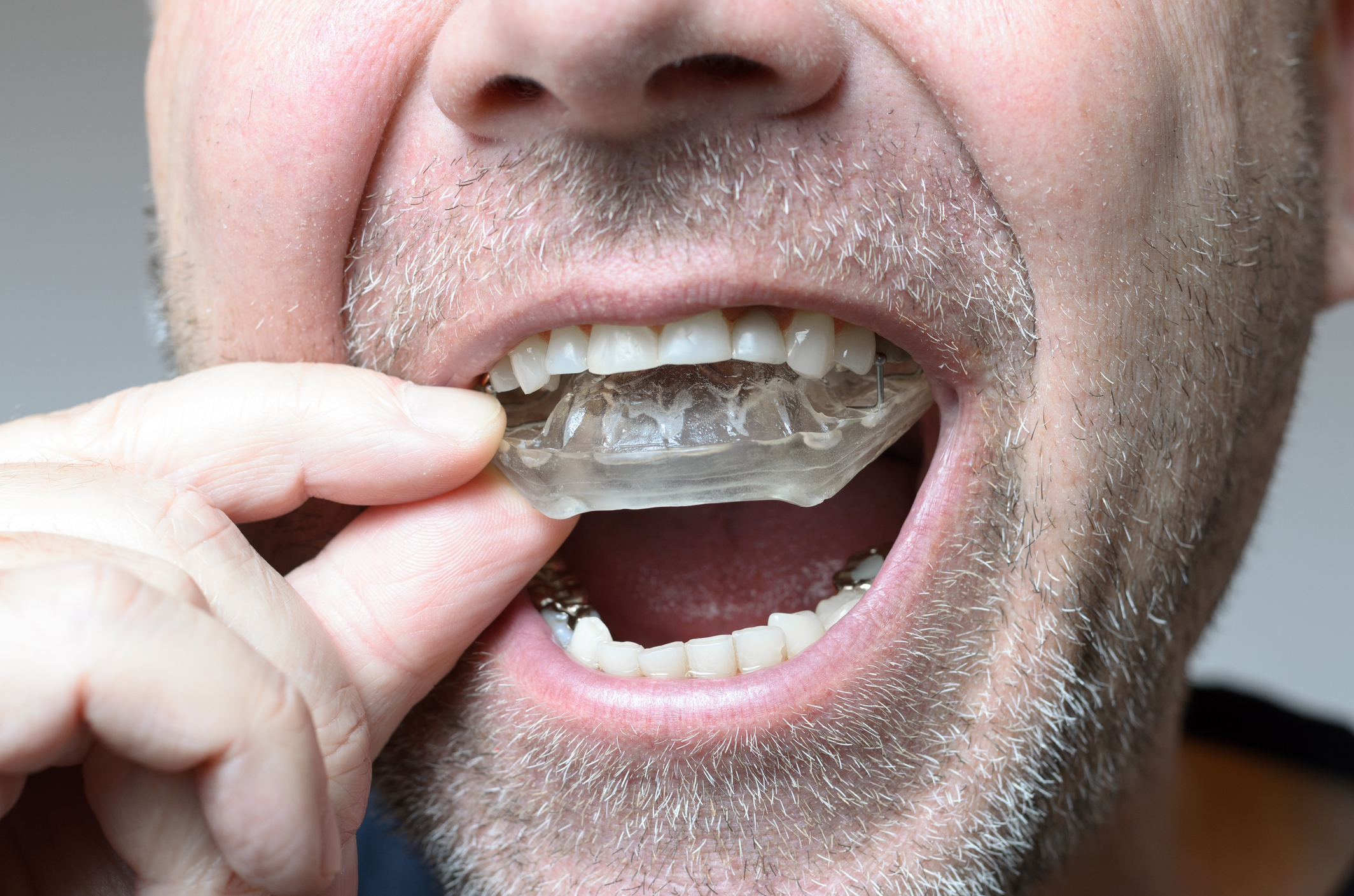 Nighttime Your Bite Your Mouthguard Could VICE Up Mess Whole -