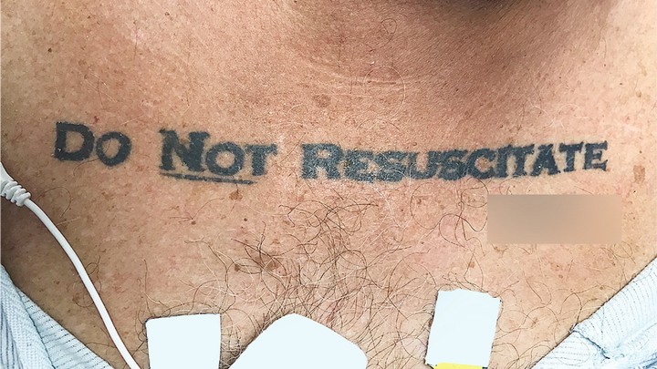 Das &quot;Nicht wiederbeleben&quot;Tattoo eines 70Jährigen stürzt Ärzte in ein