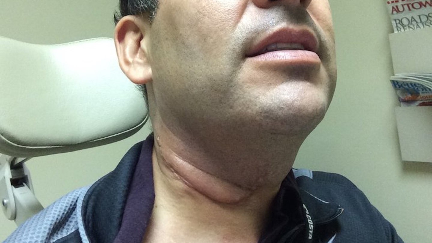 hpv symptoms on neck