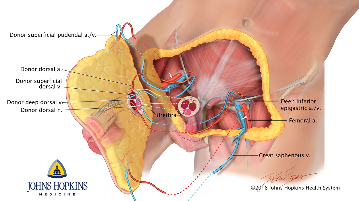 1524507217788-PenileTransplant-Diagram.jpeg