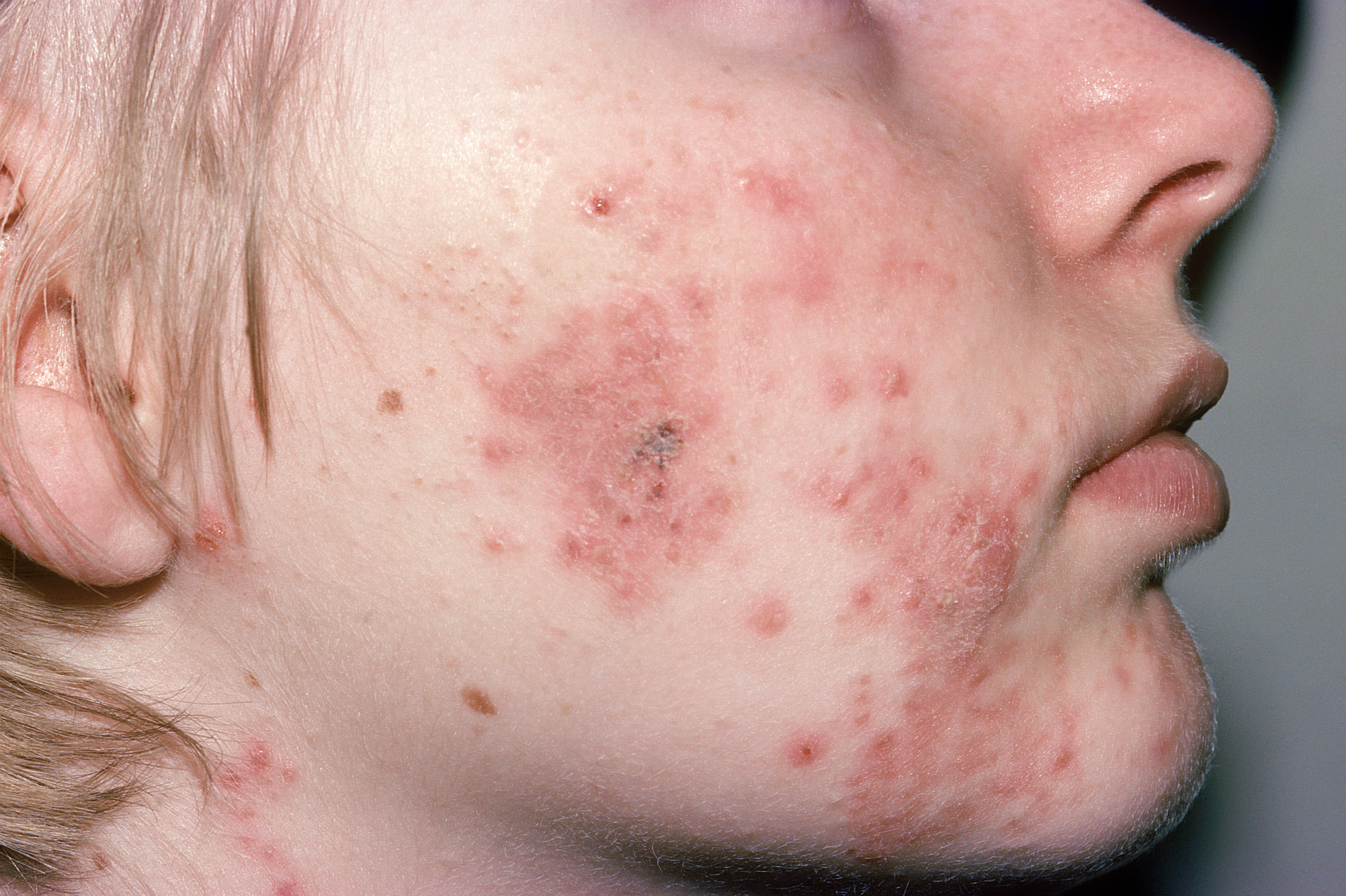 For those who have cystic acne , @hylandshealth 's PRID