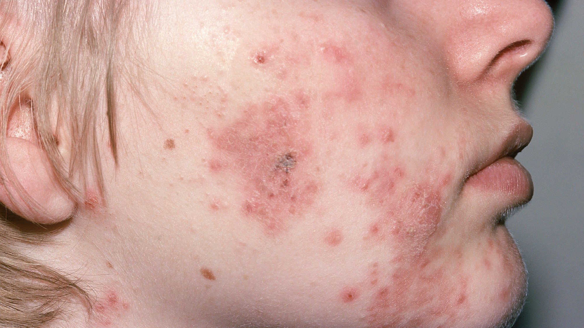 Everything You Need To Know About Treating Cystic Acne Vice