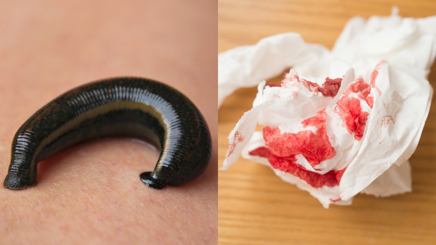 A Guy in China Found a Leech in His Throat After Coughing Blood