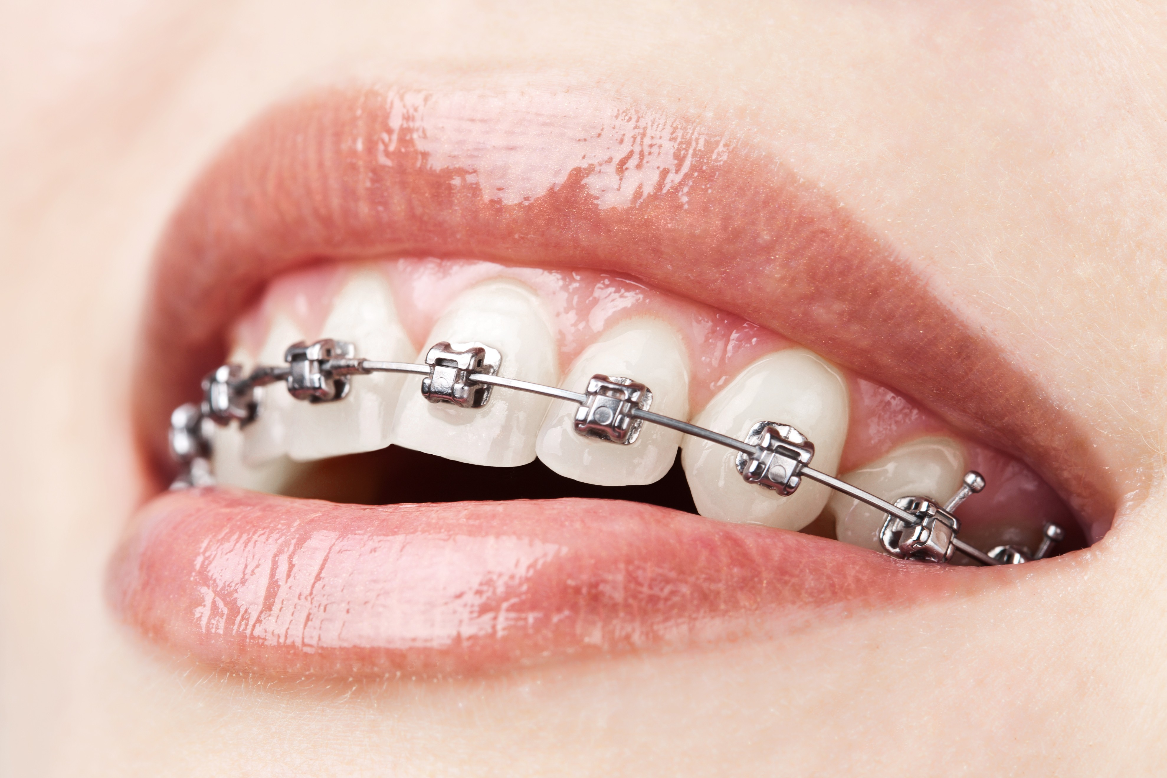 Mitos Y Verdades Sobre El Sexo Oral Con Brackets