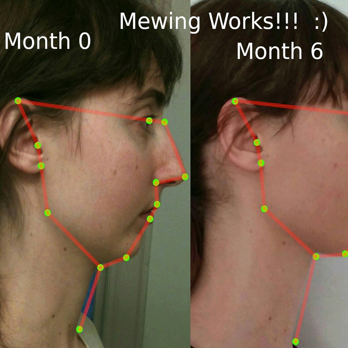 What Is Mewing and How Does it Work?