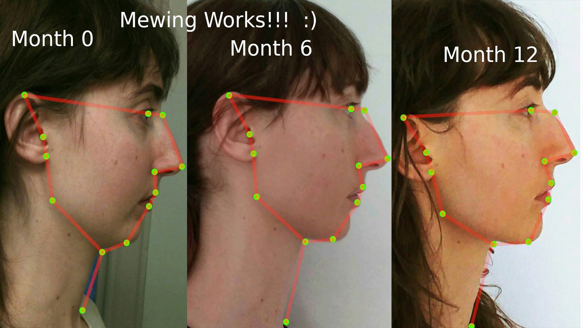 Mewing técnica que ajuda a deixar a mandíbula assimétrica - Blog 2