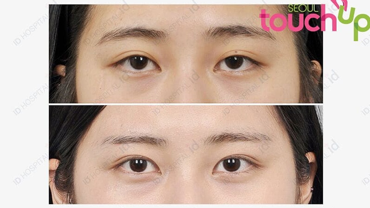 How double eyelid surgery has become a rite of passage for many South