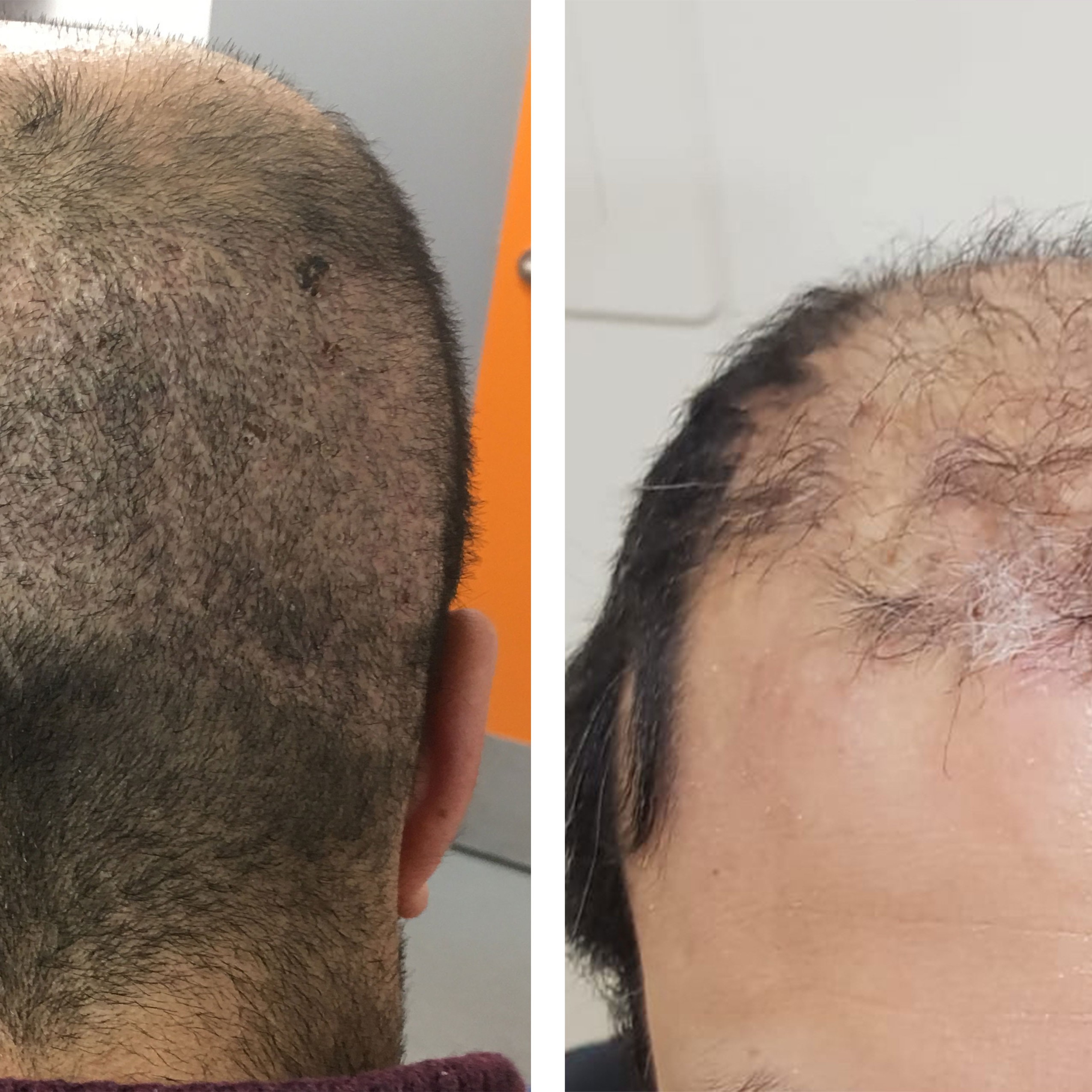 What Happens When Hair Transplants Go Wrong