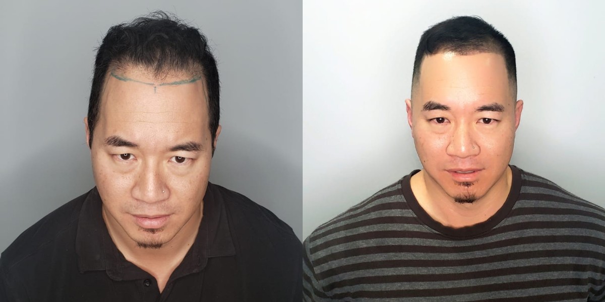 This Hair Tattoo Artist Is Inking Bald People S Heads To Fight
