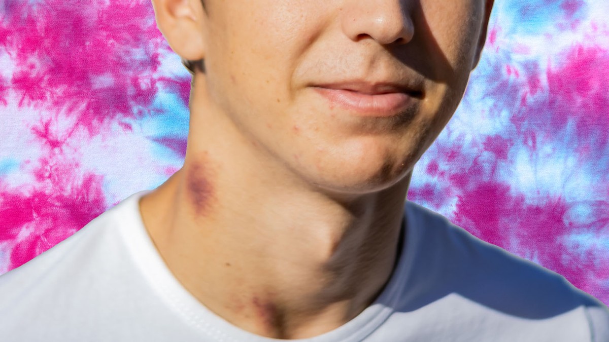 Pictures of trashy deals women with hickies