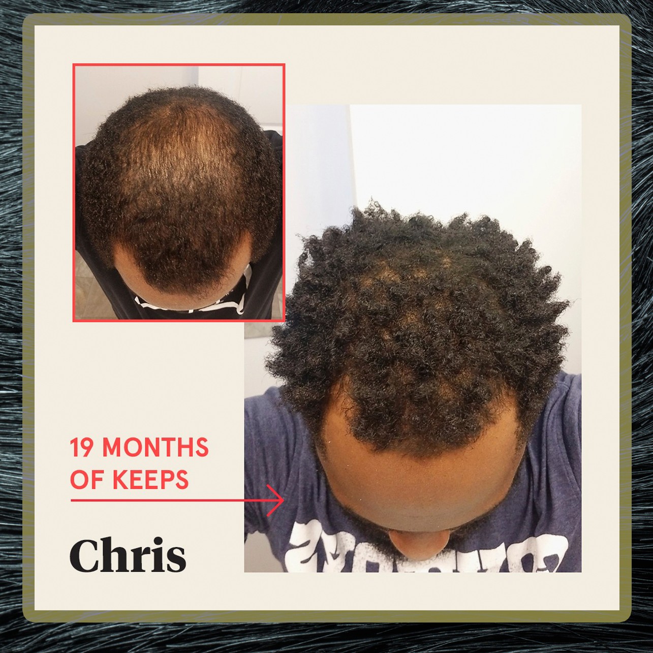 This Company Can Stop You From Balding This Company Can Stop You From Balding