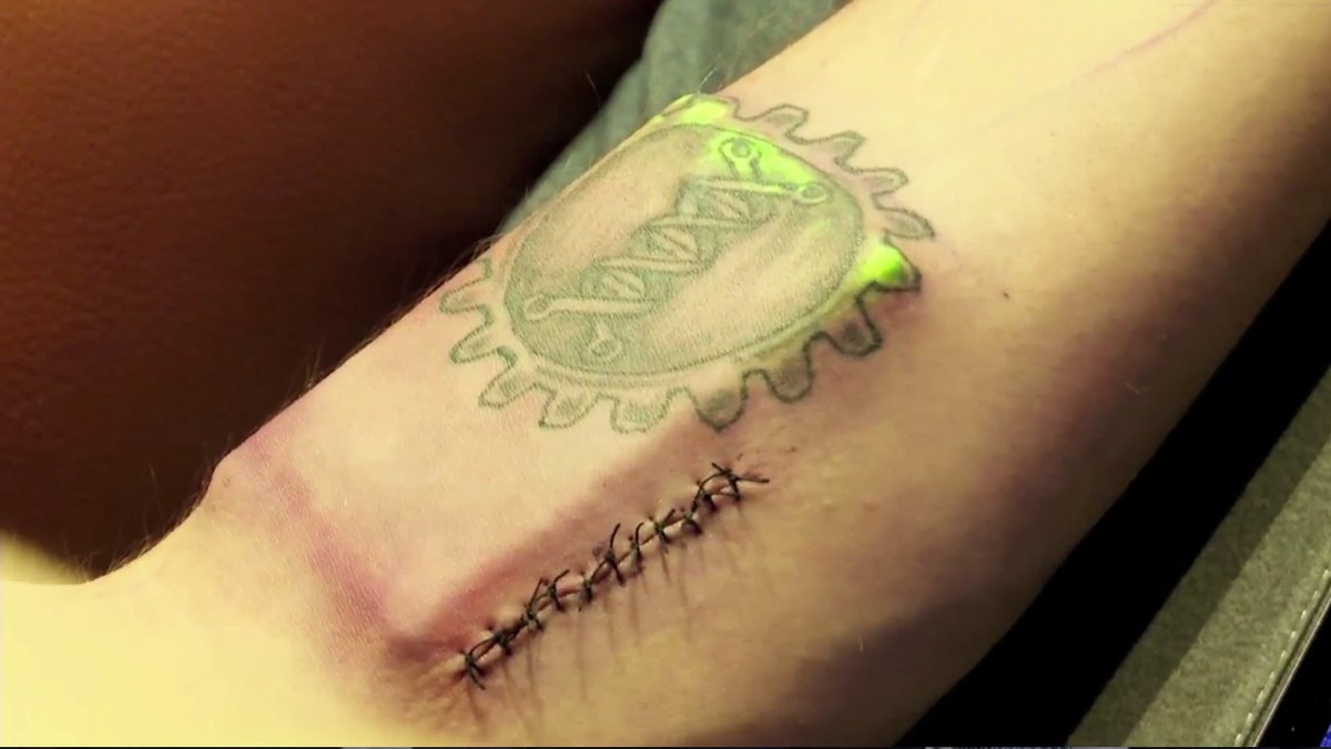 кодирование вшивание ампулы. кардиостимулятор серд. силиконовые импланты под кожу. Existence тату. электронные чипы под кожей.