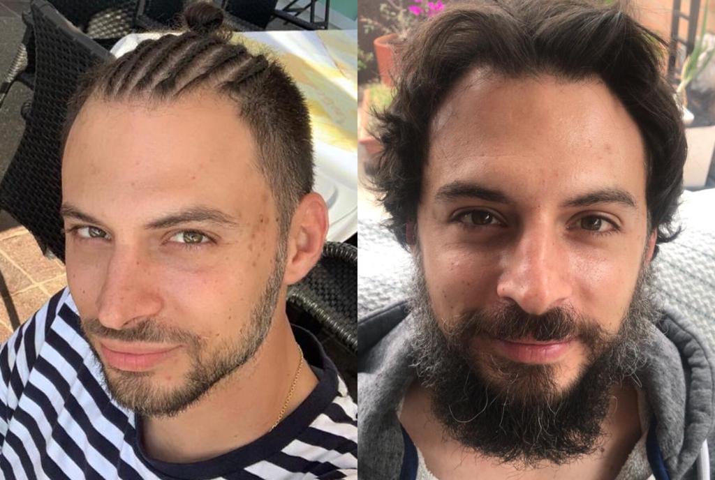 barba antes y después