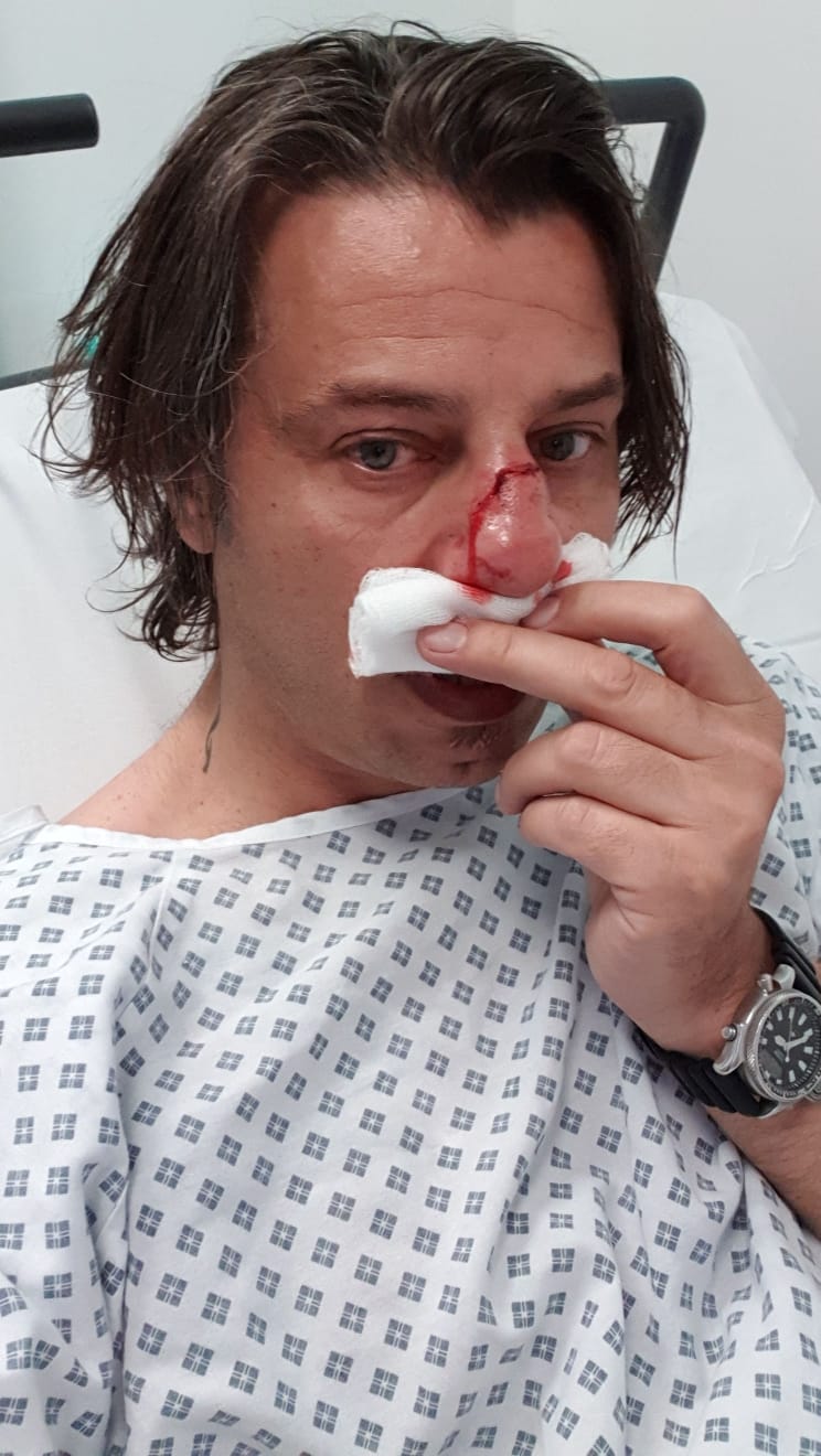 Corrado Amitrano in hospital with broken nose after the far-right protest in London