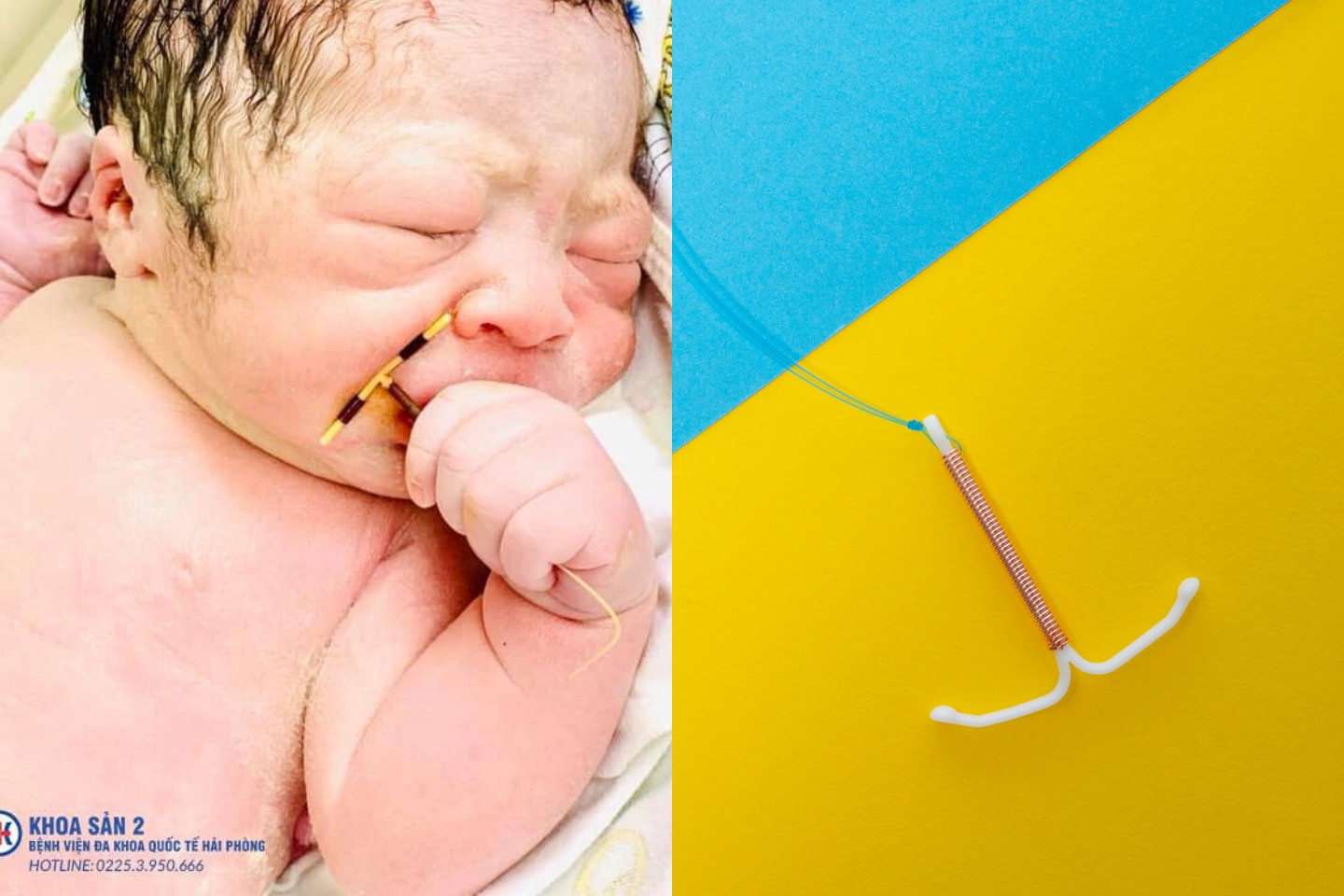 Vietnamese Baby Came Out Of The Womb Holding His Mother S Iud