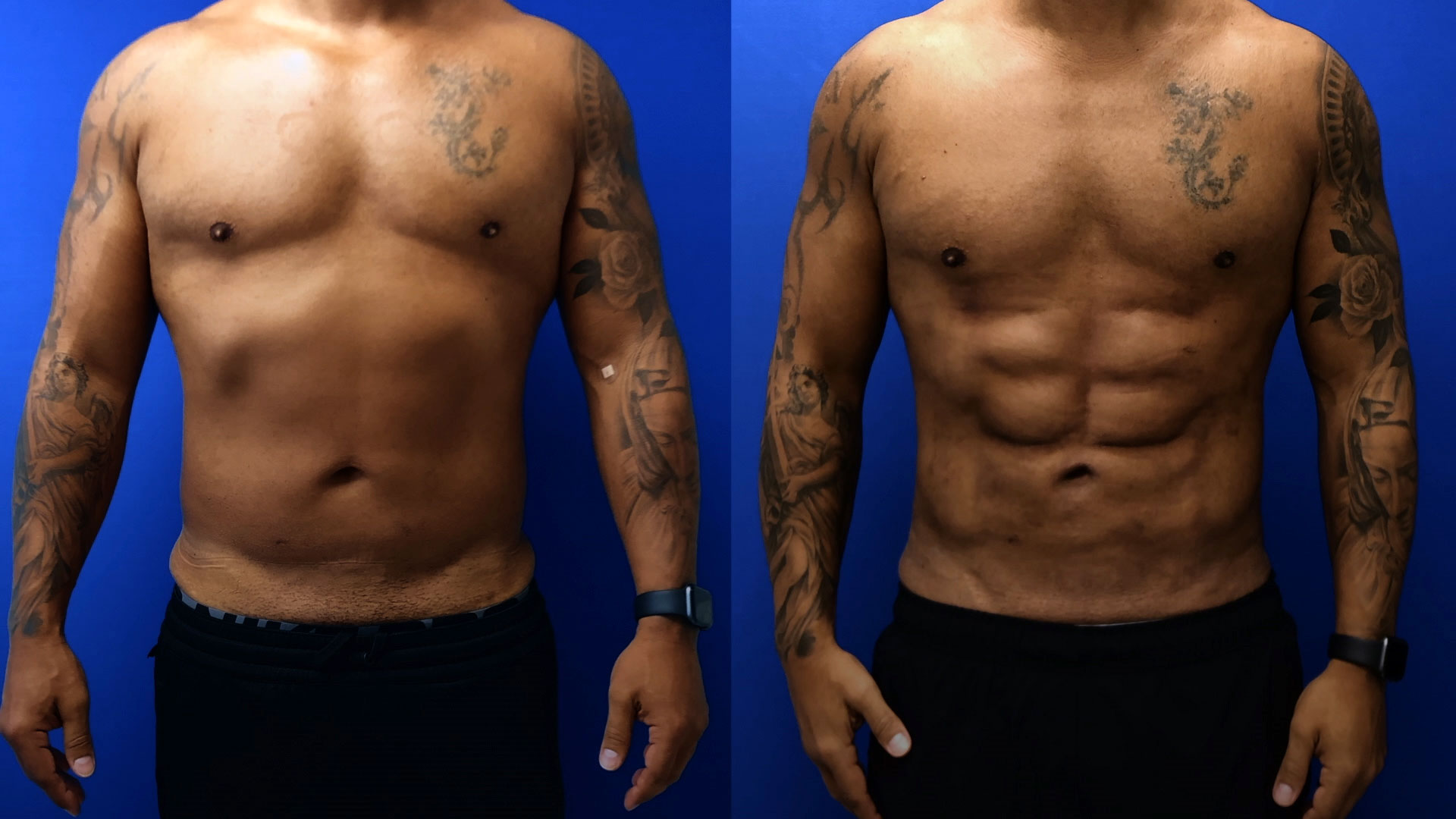 Are 6-pack Abs Possible after a Male Tummy Tuck? Yes, They Are! –  Aristocrat Plastic Surgery